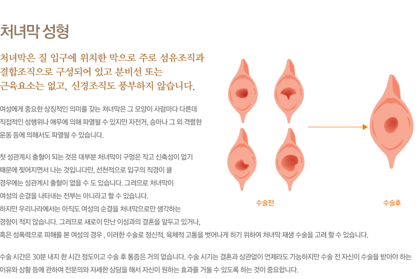 처녀막 성형